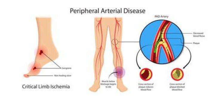 Which is the most common location for peripheral artery disease?