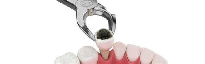 Which teeth are the hardest to pull out?