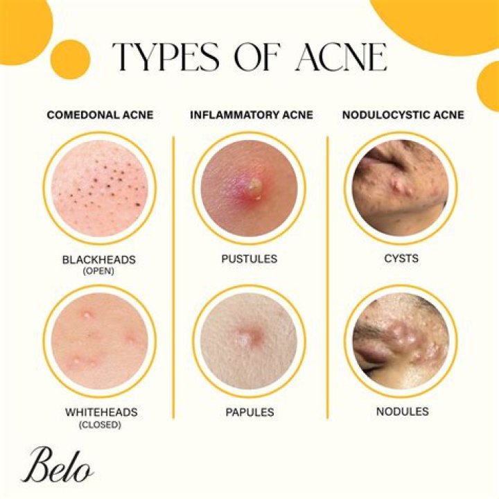 Who discovered acne?