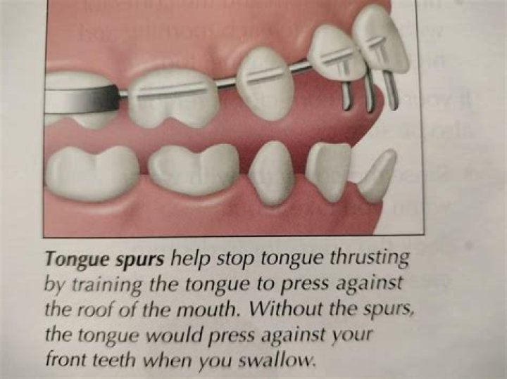 Who treats tongue thrust?