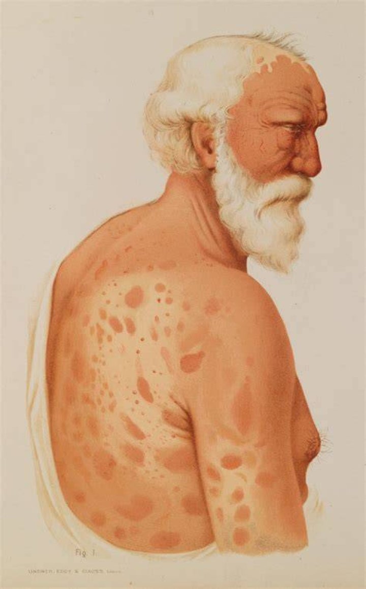 Who was the first person to get leprosy?