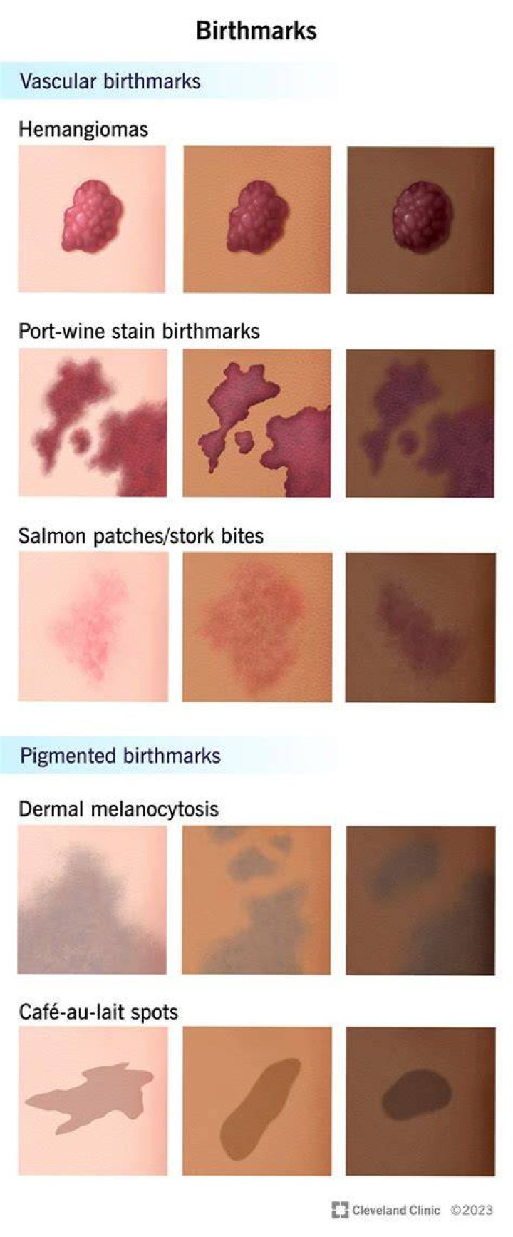 Why are birthmarks called birthmarks?