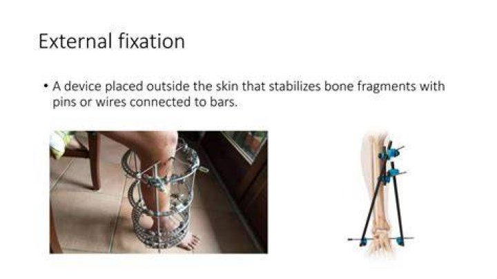 Why are ex fix used?