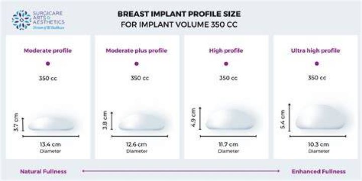 Why are my implants so high?