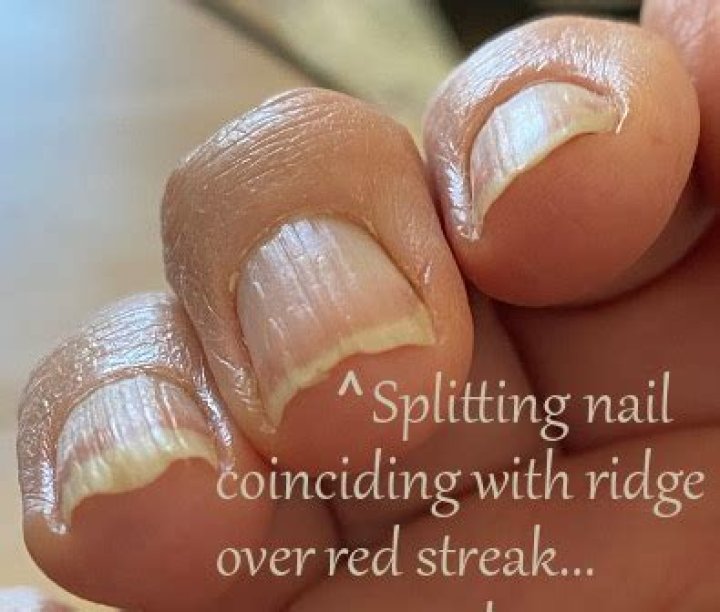 Why are my nails splitting lengthwise?