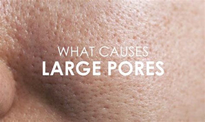 Why are my pores so big?