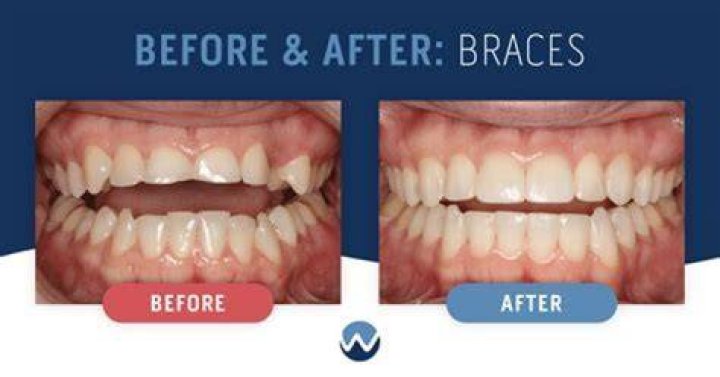 Why are my teeth so big after braces?