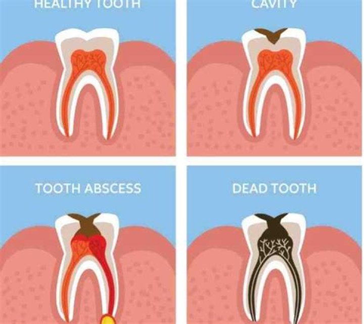 Why are root canals painful?