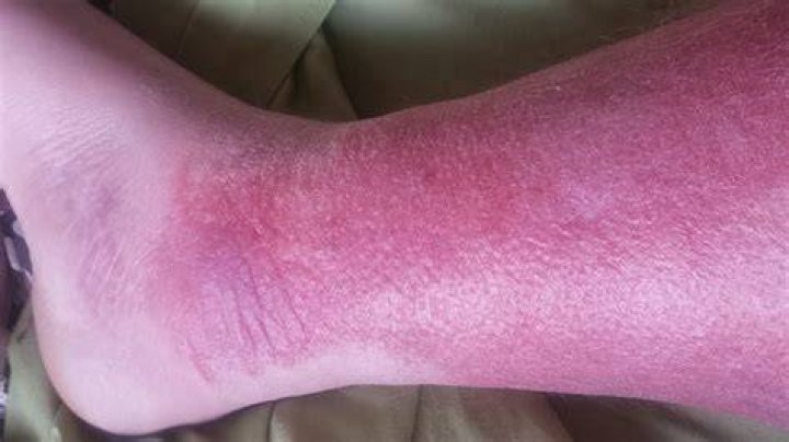 Why are the lower part of my legs red?