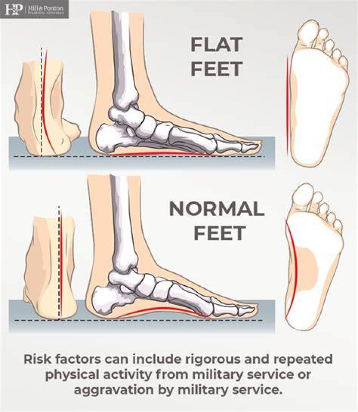Why can't flat feet serve in military?