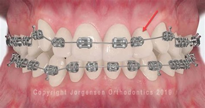 Why did my orthodontist put a wire around my bracket?