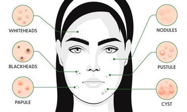 Why do girls get pimples?