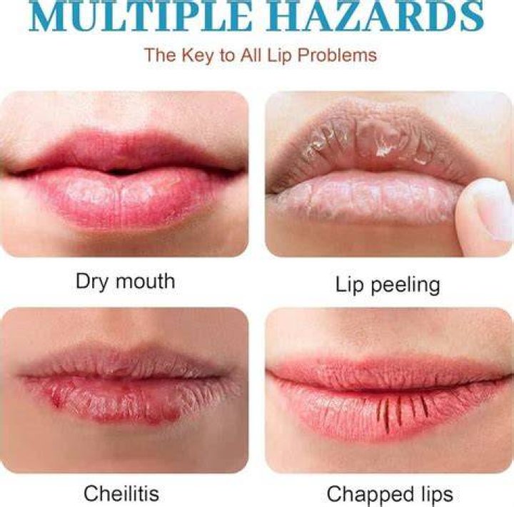 Why do I always have cracked lips?