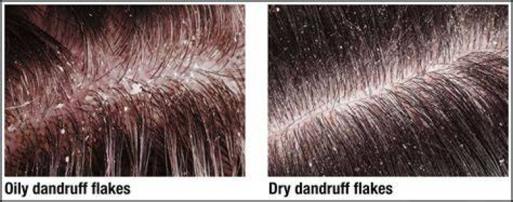 Why do I have huge flakes of dandruff?