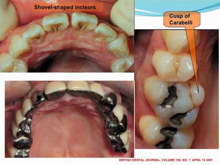 Why do I have shovel teeth?