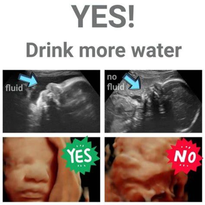 Why do I have to drink water before an ultrasound?