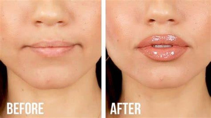 Why do lips get bigger?