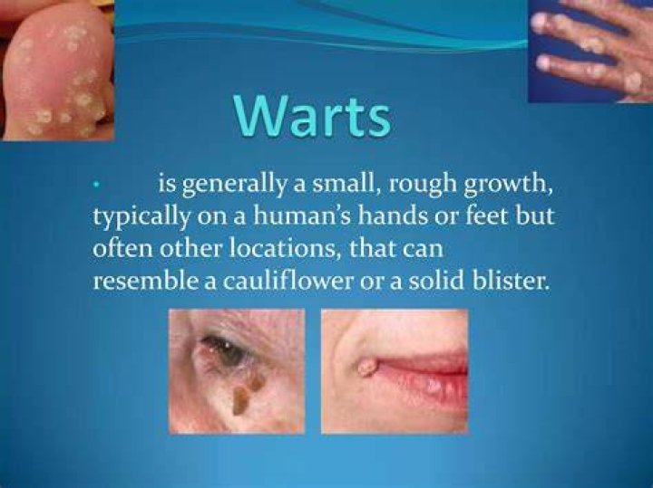 Why do people get warts?