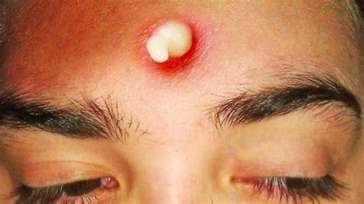 Why do some zits have a seed?