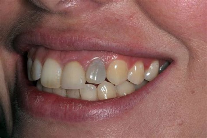 Why does a tooth turn GREY?