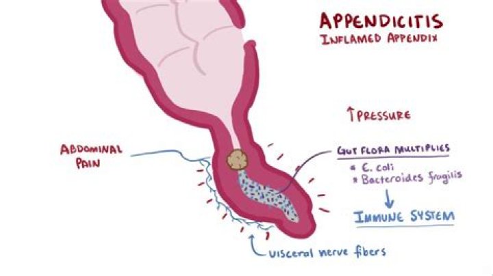 Why does appendix burst?