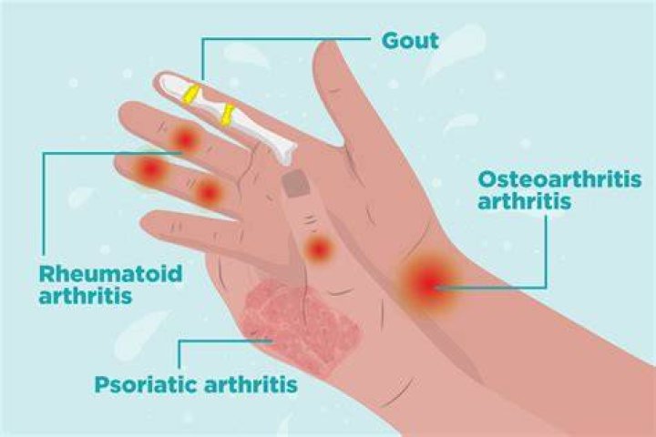 Why does rheumatoid arthritis hurt so much?