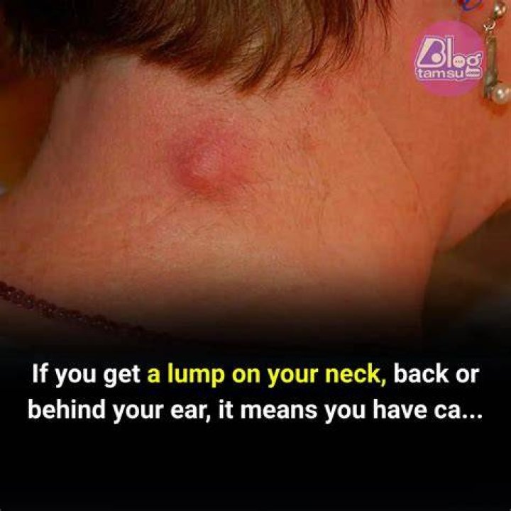 Why have I got a lump in my neck for years?