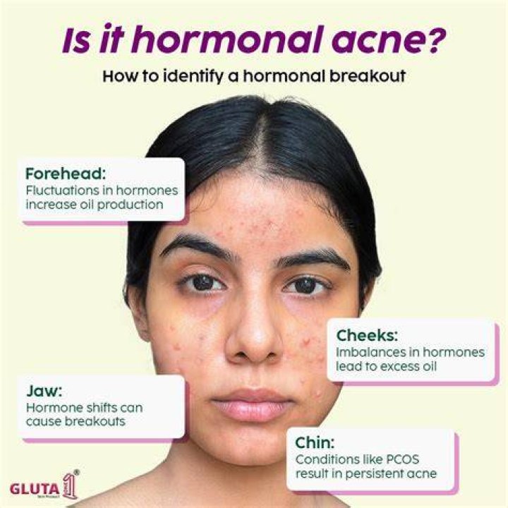 Why is hormonal acne on chin?
