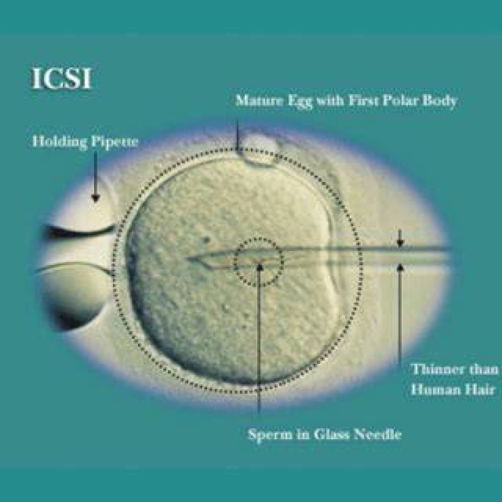 Why is ICSI used in IVF?