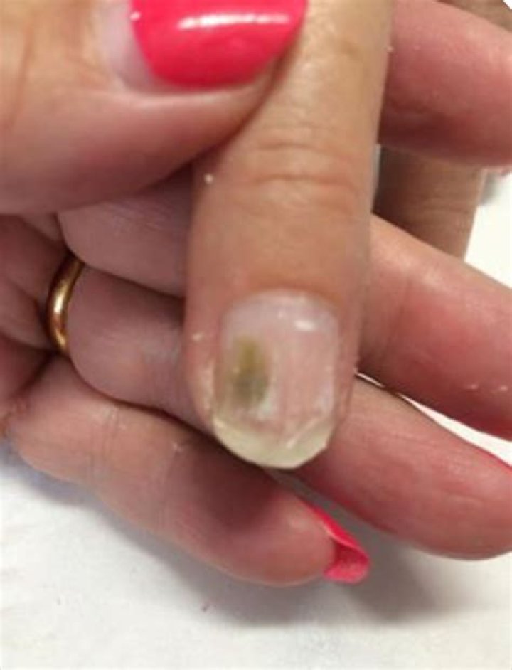 Why is my nail green?