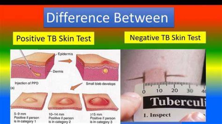 Why is my TB test itchy?