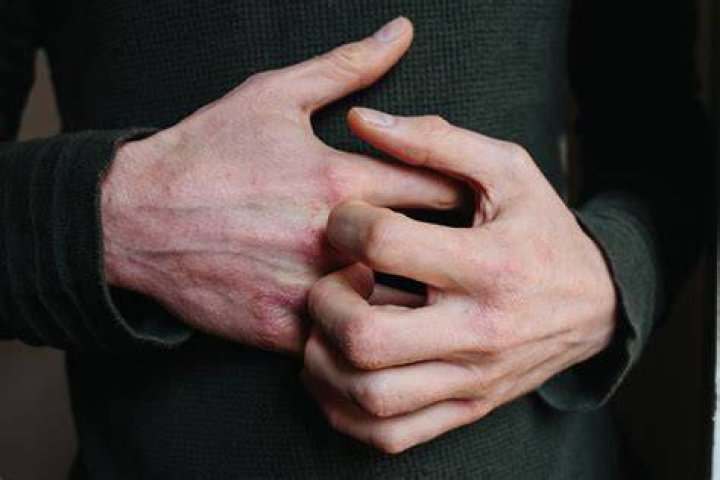 Why won't my eczema go away?