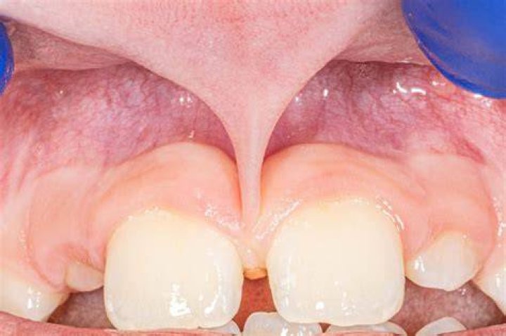 Will a frenectomy close a gap?