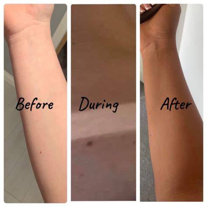 Will a spray tan cover up vitiligo?