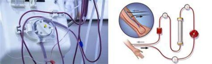 Will dialysis remove fluid from lungs?