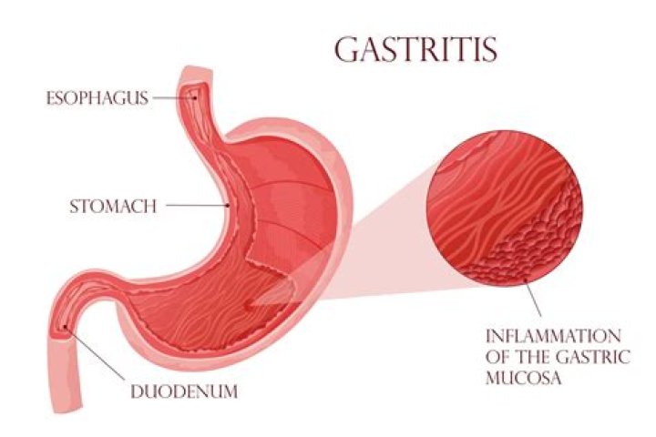 Will gastritis go away?