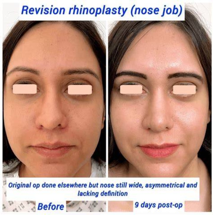 Will wearing a mask ruin my rhinoplasty?
